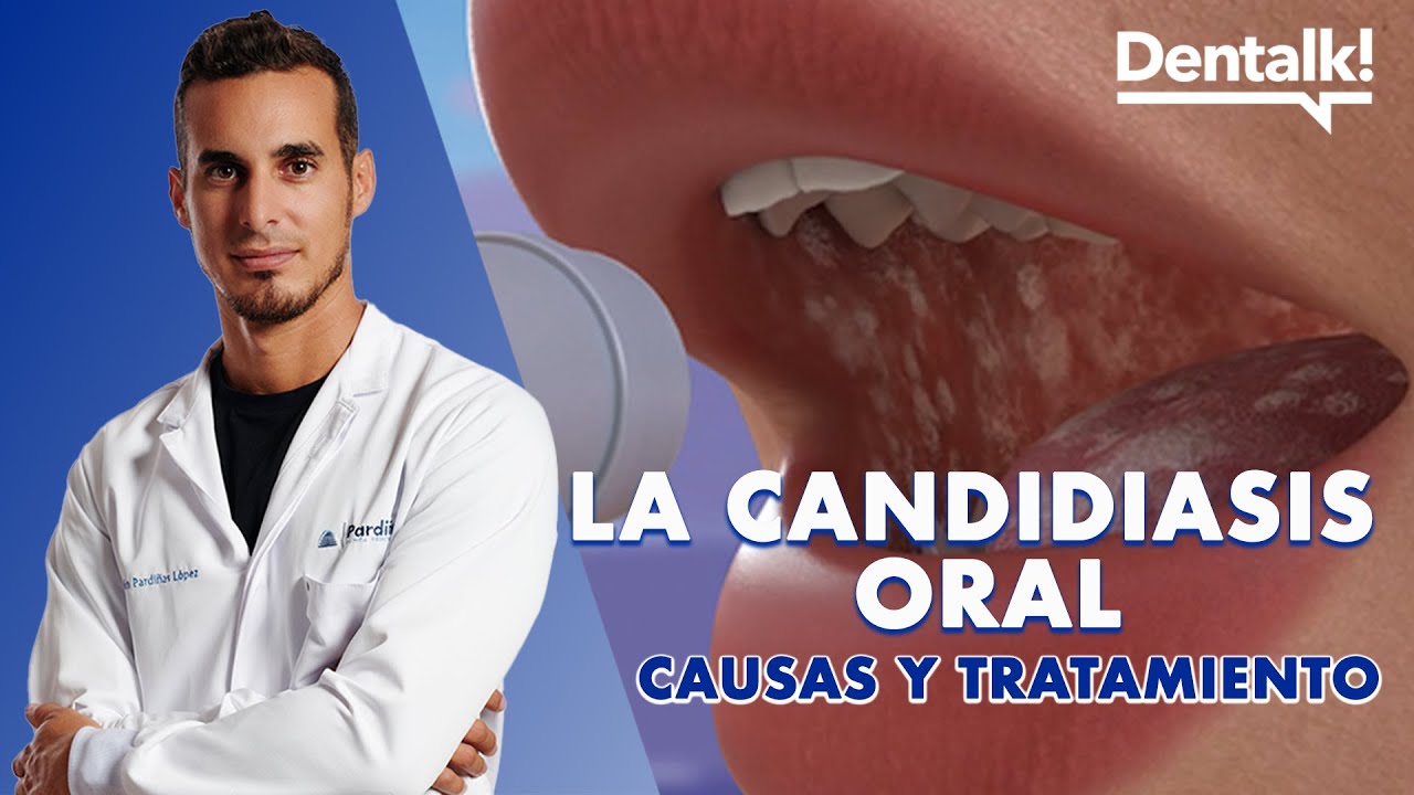 grietas en la lengua por hongos