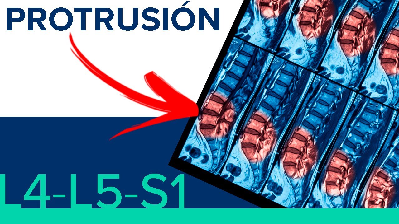 hernia discal l3 l4 l5 s1 tratamiento