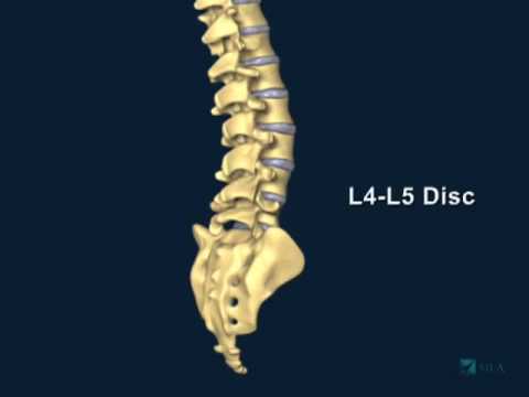 hernia discal l3 l4 y l4 l5