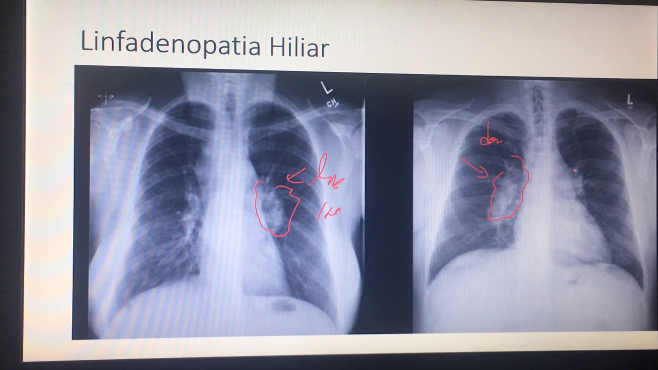 hilios de aspecto vascular es grave