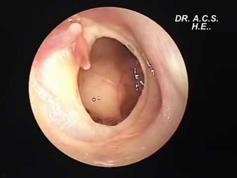 instrumento para explorar el oído y el tímpano