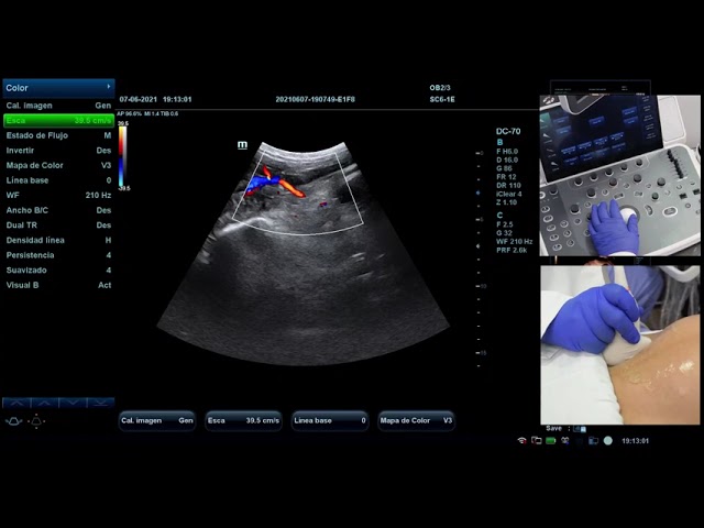 ip medio arterias uterinas semana 12