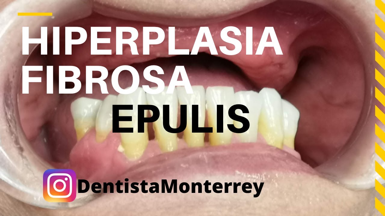 lesiones en la encía por prótesis