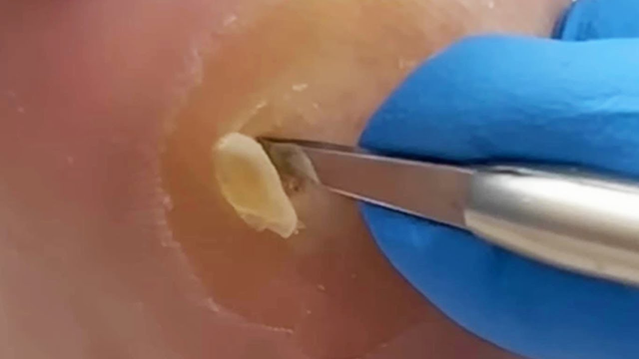 ojo de gallo en el talon