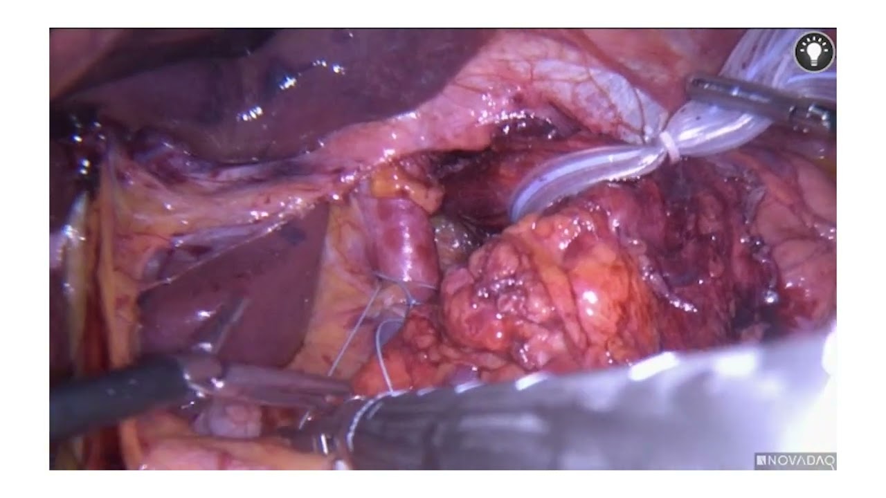 operacion de hernia de hiato por laparoscopia