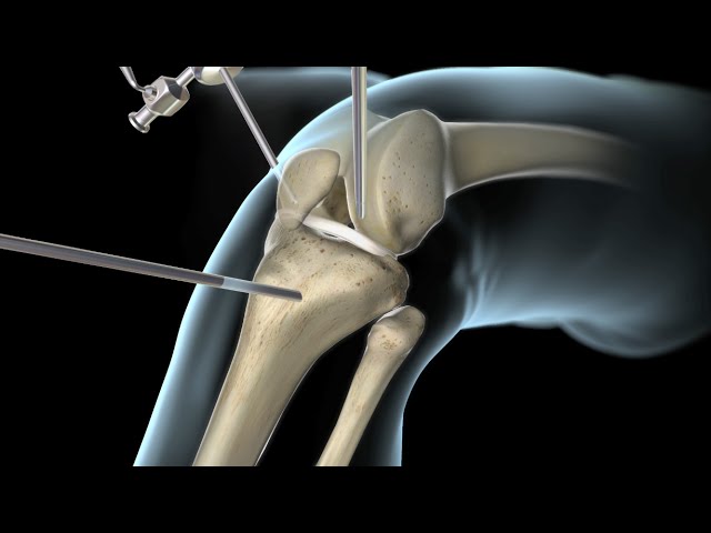 operacion ligamento cruzado anterior y meniscos