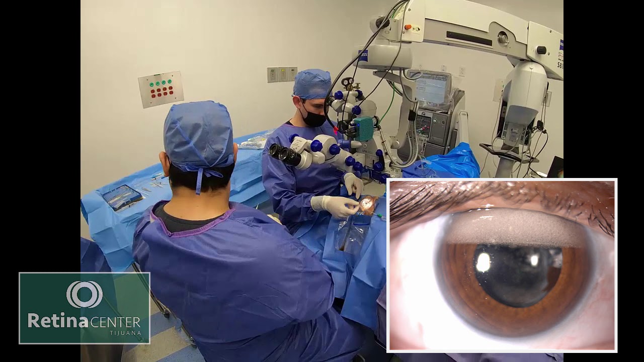 postoperatorio desprendimiento de retina con silicona