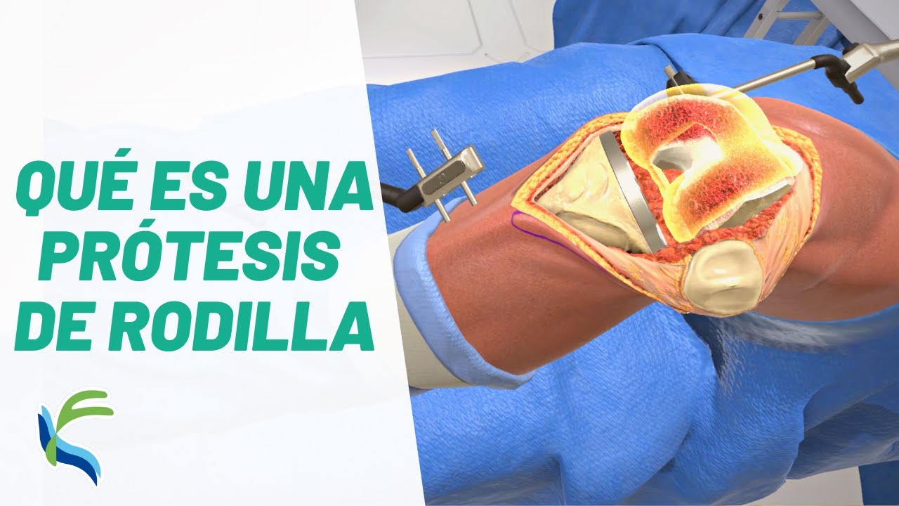 protesis de rodilla operacion y recuperacion