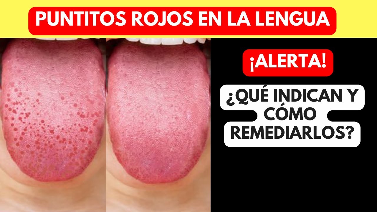 puntos rojos debajo de la lengua