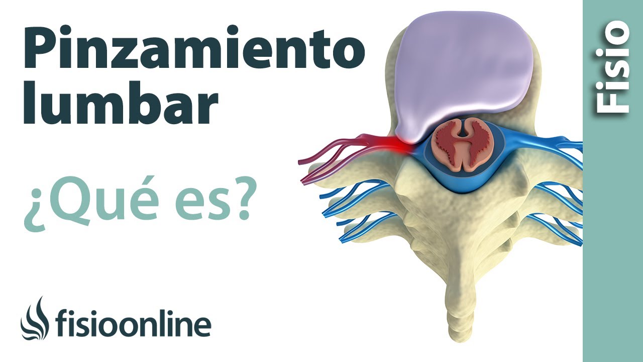 que es un pinzamiento en la espalda