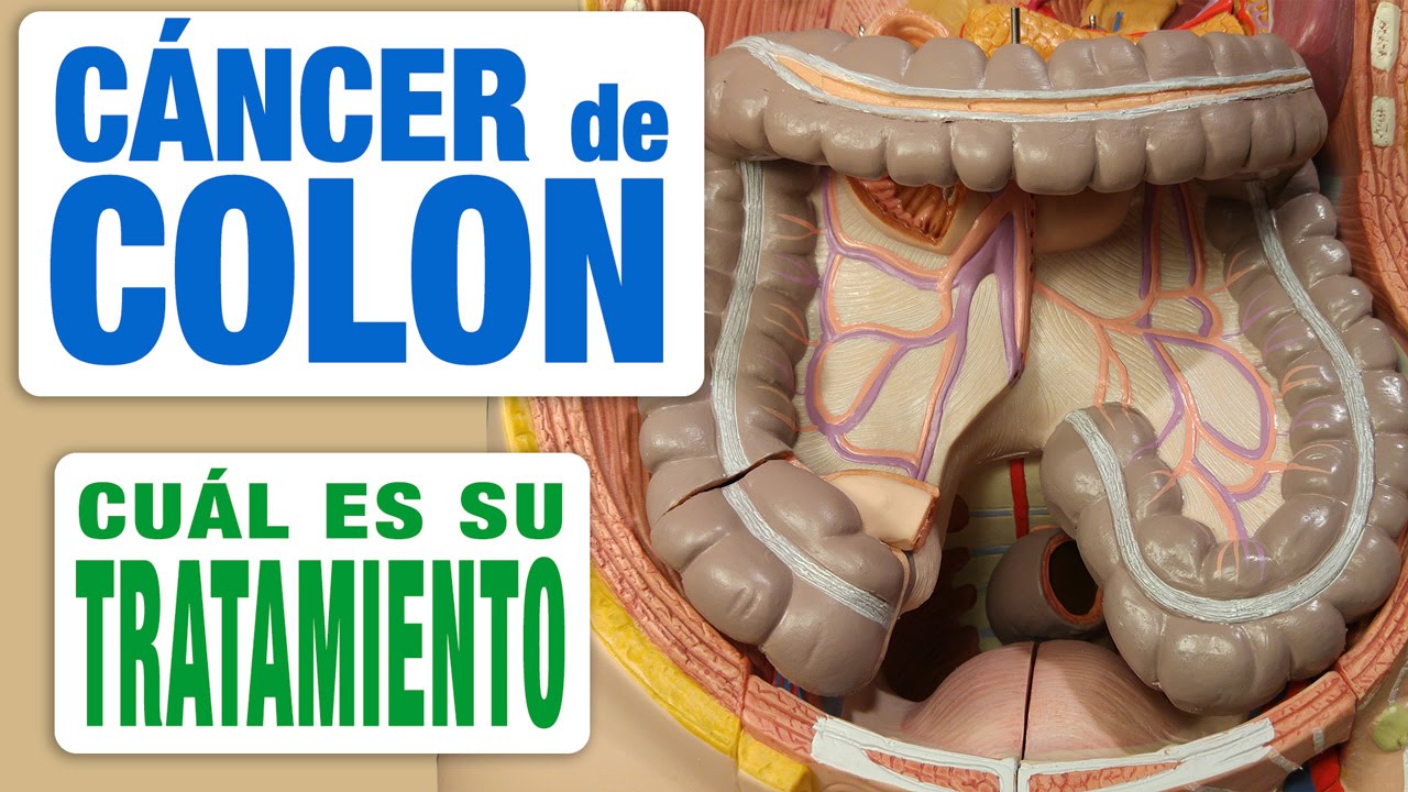 quimioterapia en pastillas para cáncer de colon