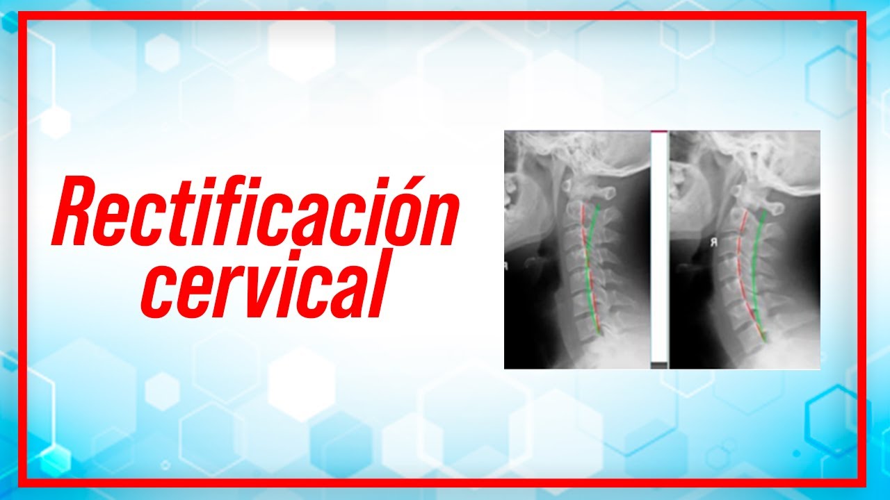 rectificación de la lordosis cervical síntomas