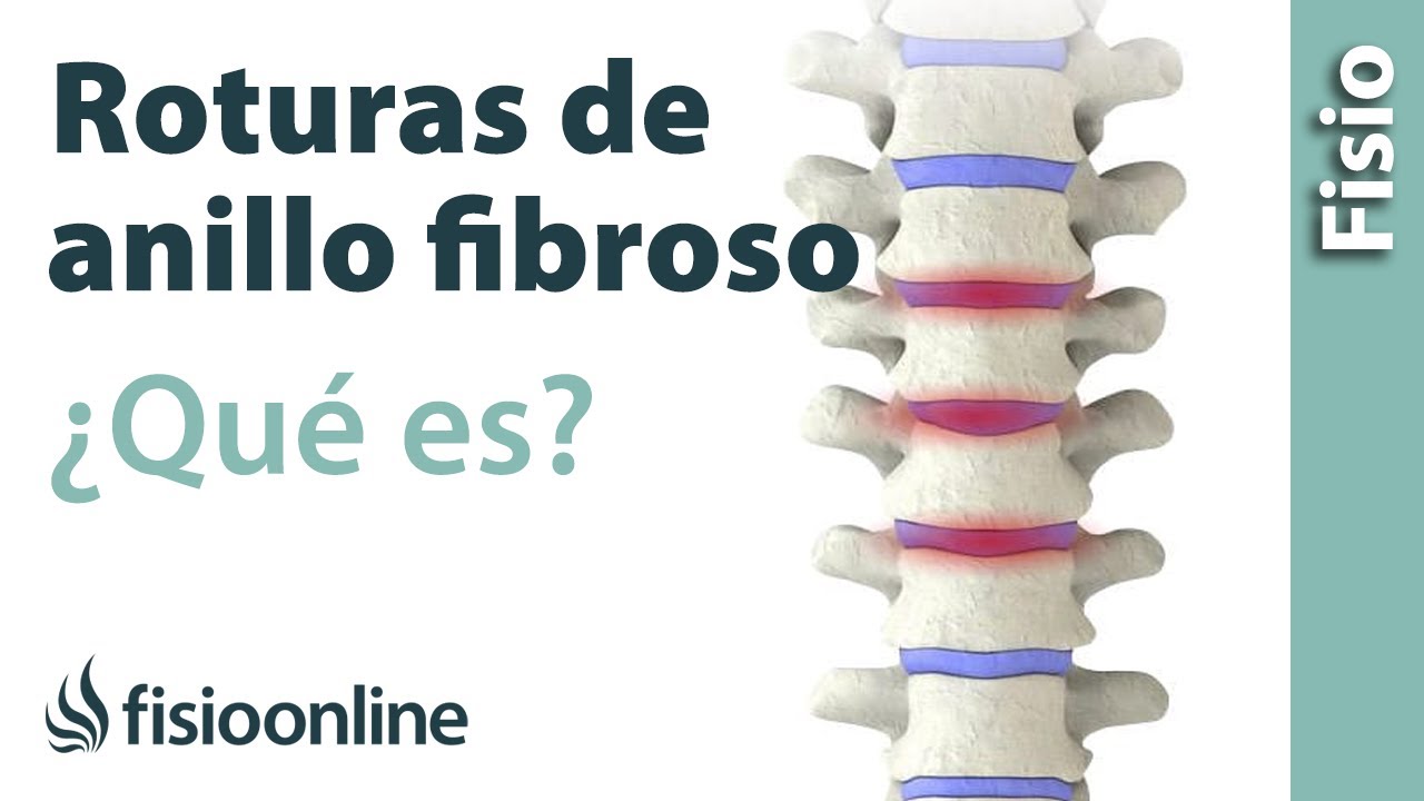 rotura anillo fibroso l5 s1 síntomas