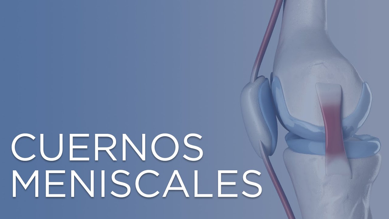 rotura degenerativa del cuerno posterior del menisco interno
