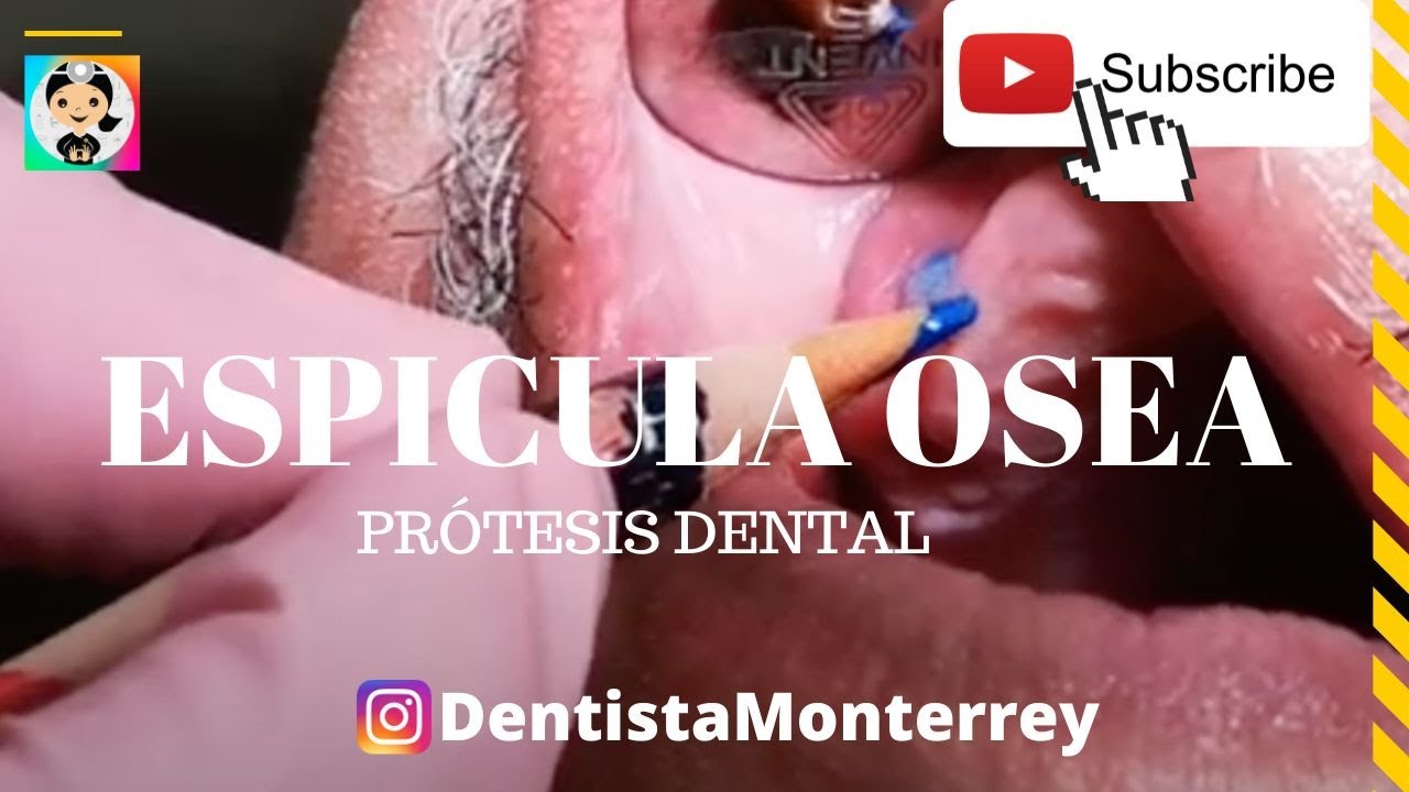 se ve el hueso después de una extracción