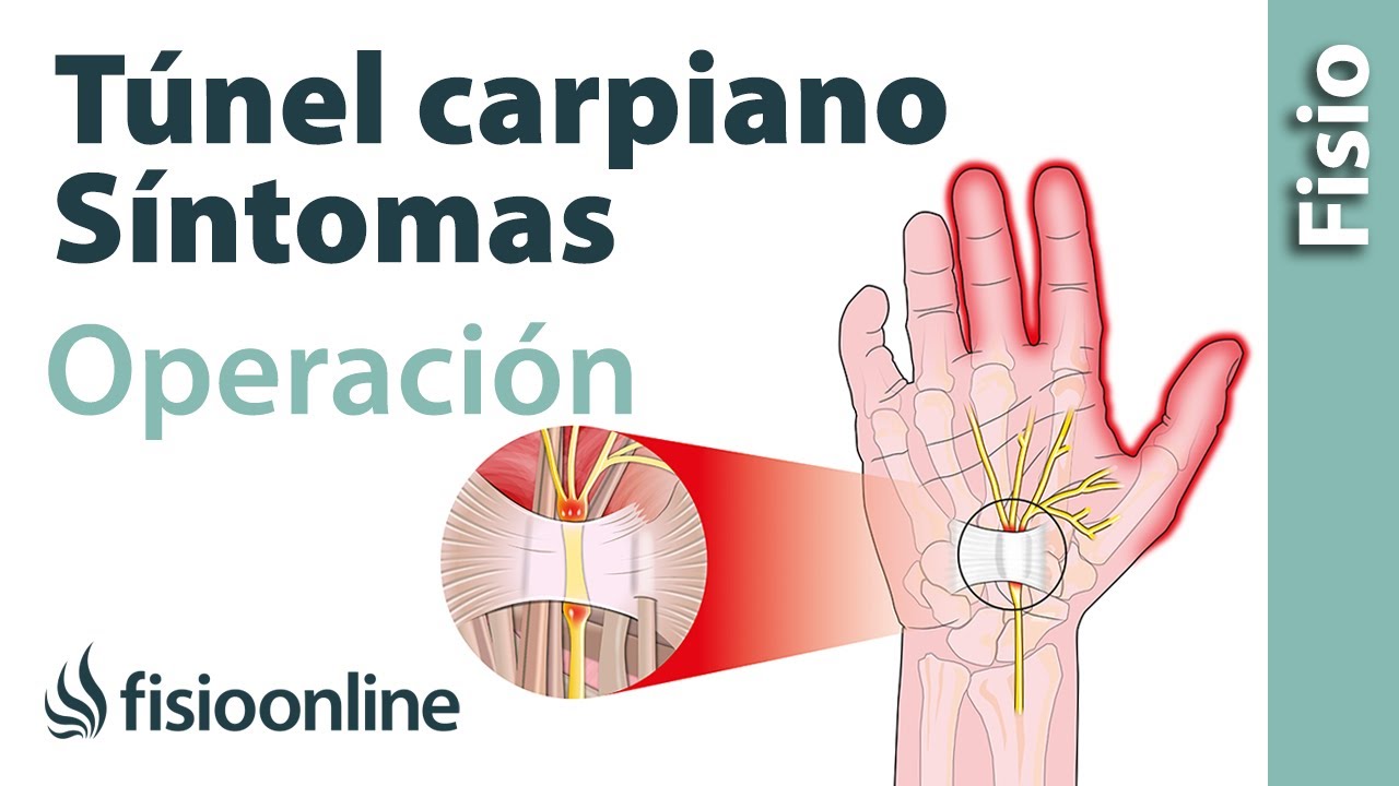 secuelas despues dela operacion del tunel carpiano