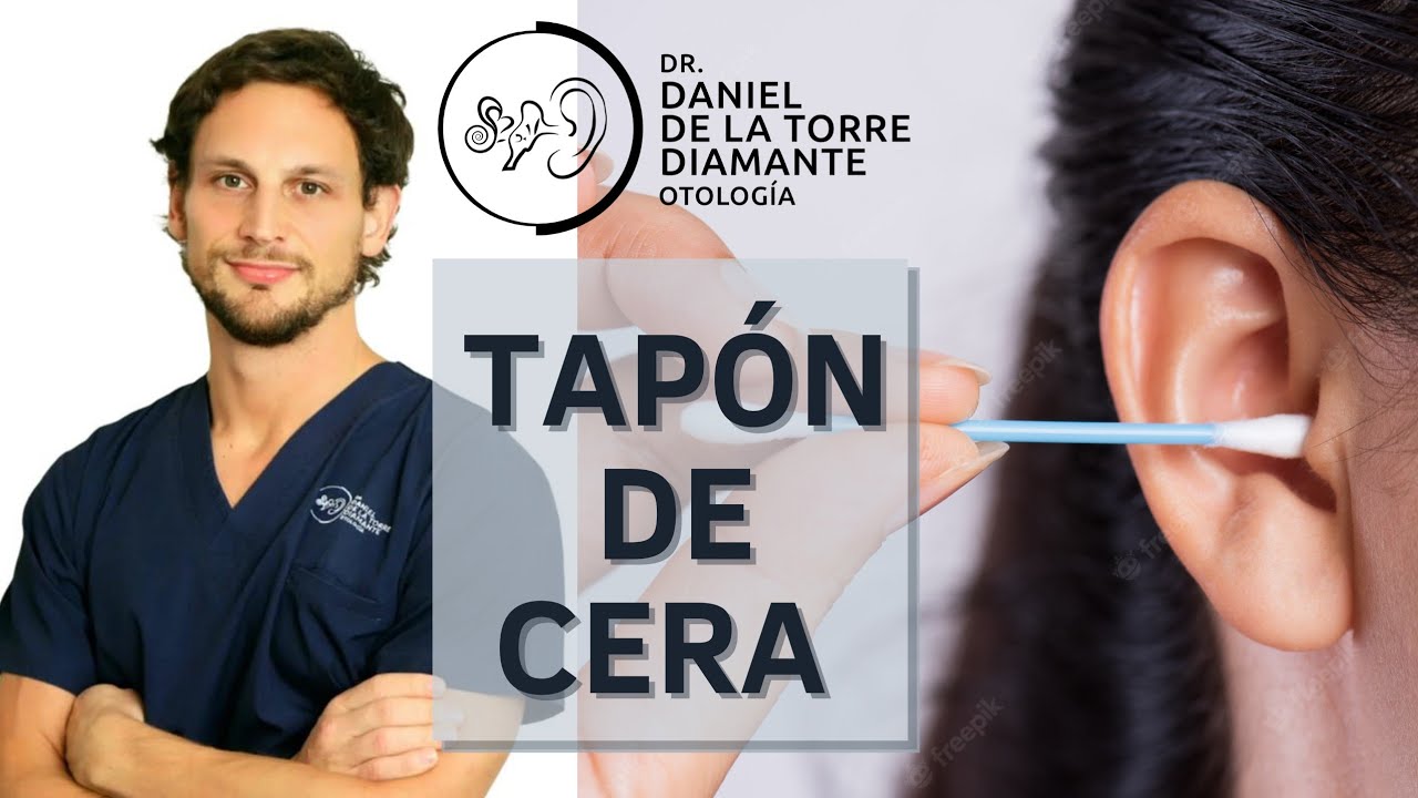 sintomas de un tapon en el oido