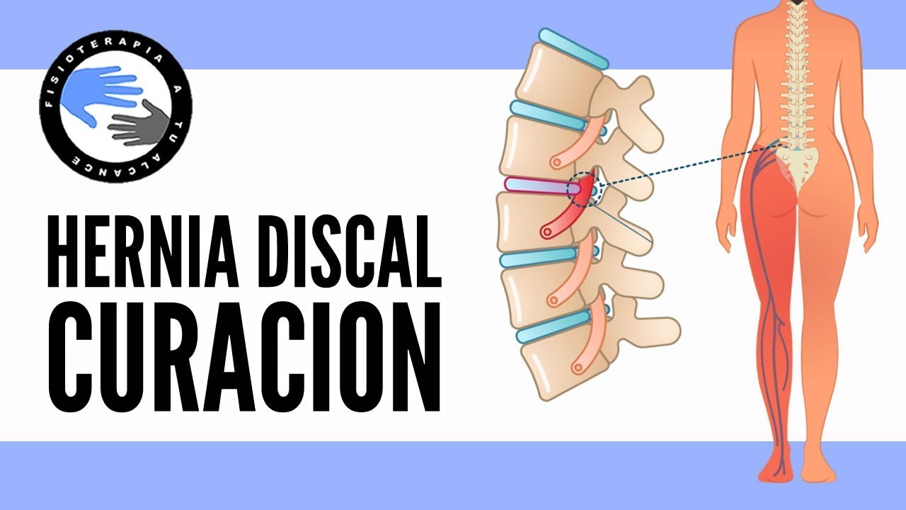 tiempo de baja por protusión discal lumbar