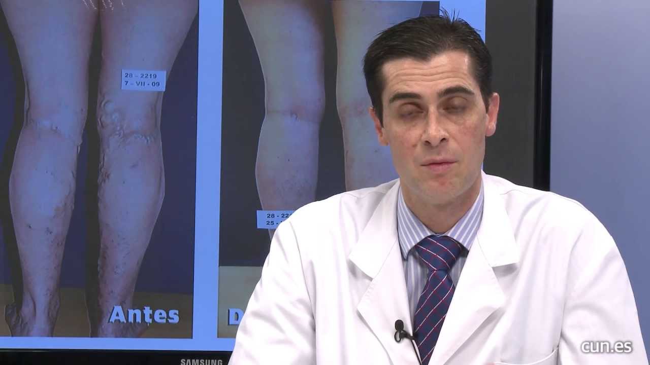 ulceras en las piernas en ancianos