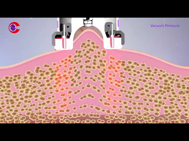 vacumterapia en abdomen antes y despues