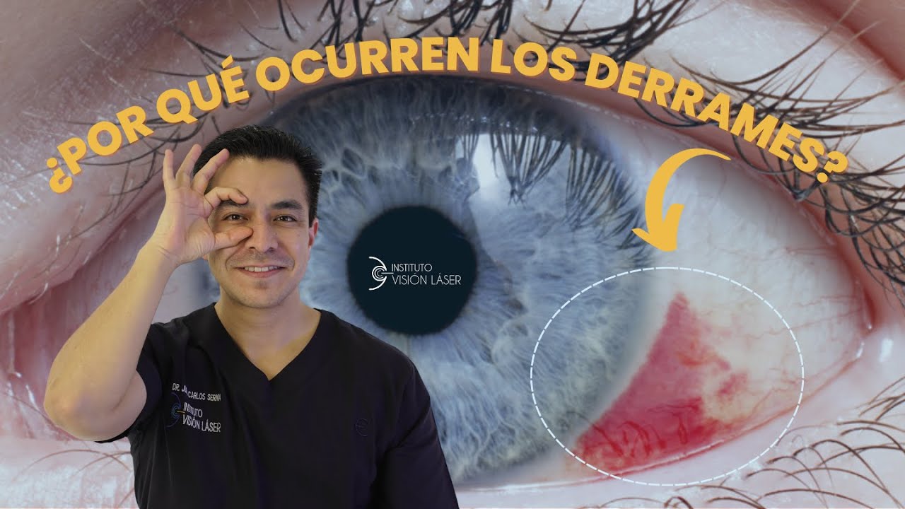 venas rojas en los ojos por estrés