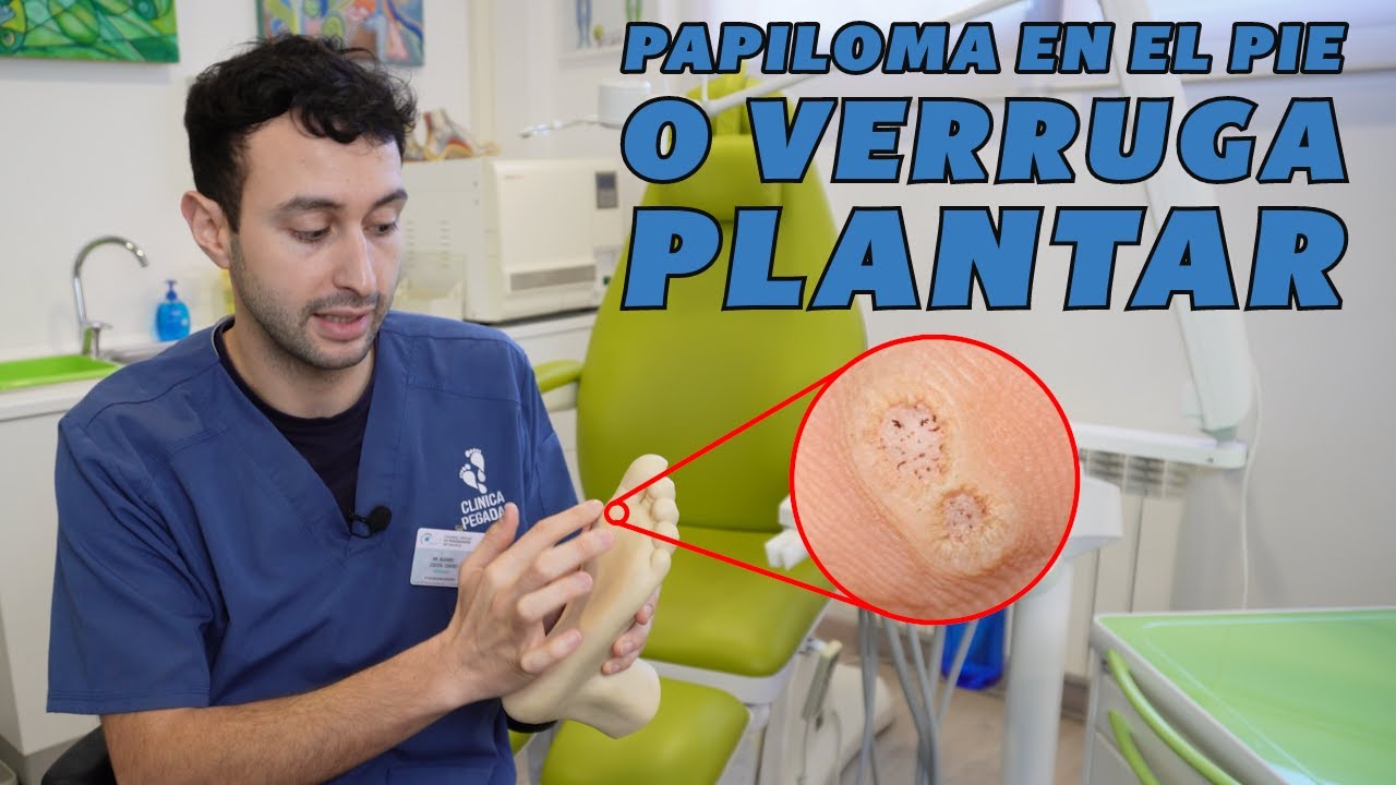 virus papiloma humano en el pie