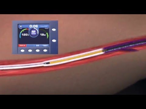 ablación de vena safena por radiofrecuencia