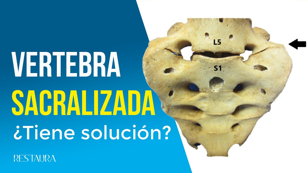 anomalía de transición lumbosacra con sacralización de l5