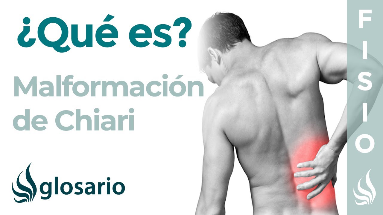arnold chiari tipo 1 y minusvalía