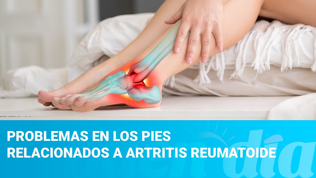 artritis en los dedos de los pies