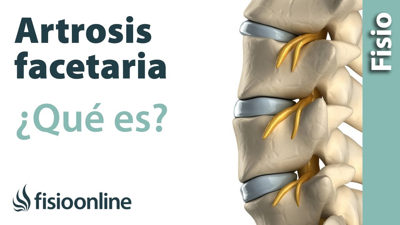 artrosis interapofisaria l4 l5 y l5 s1