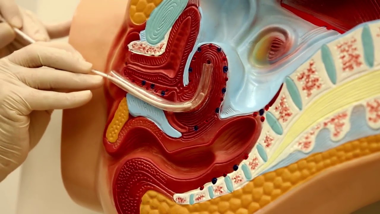 biopsia endometrial con cánula de cornier