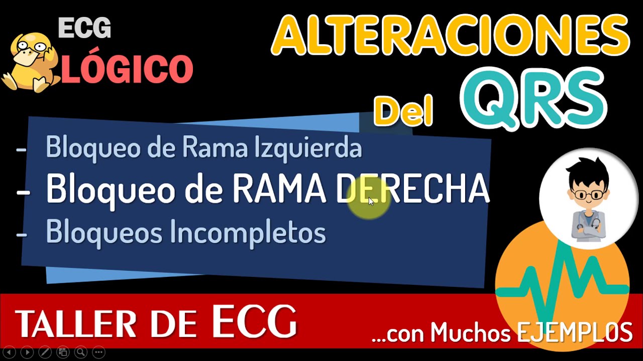 bloqueo completo de rama derecha electrocardiograma