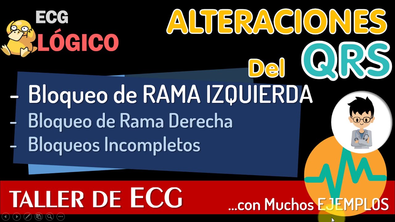 bloqueo completo de rama izquierda ecg