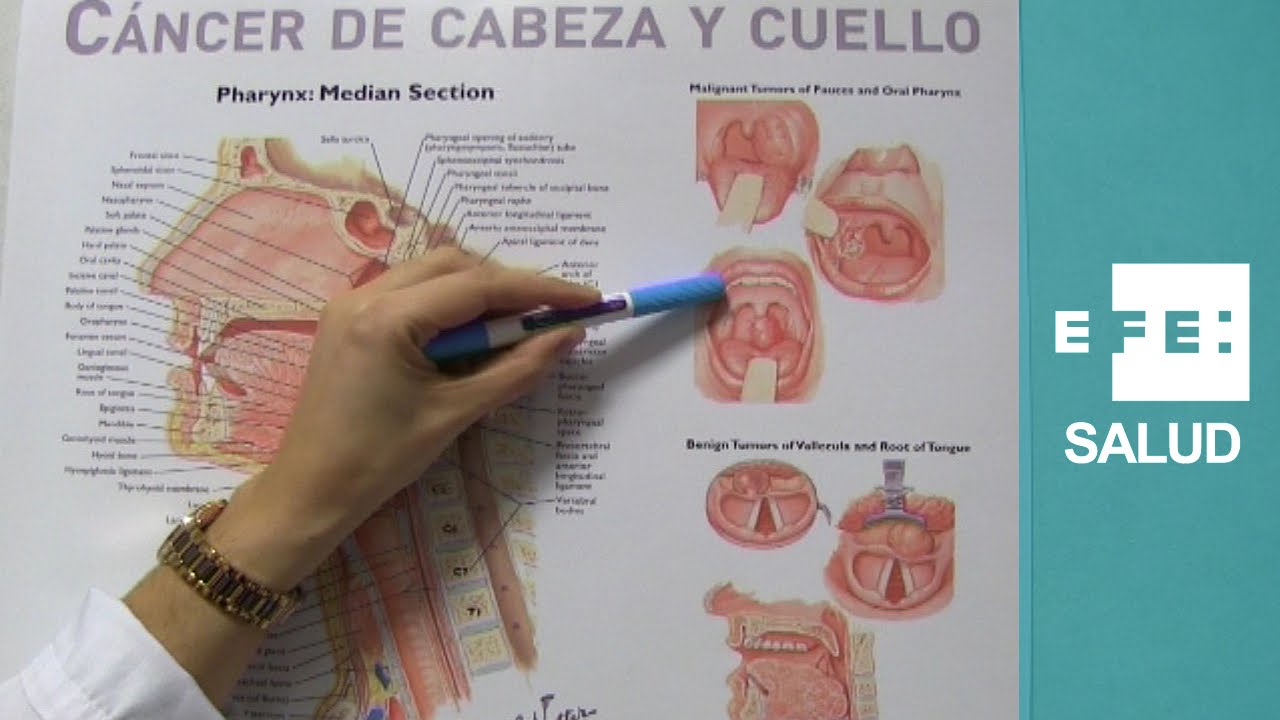 bulto en el paladar por fumar