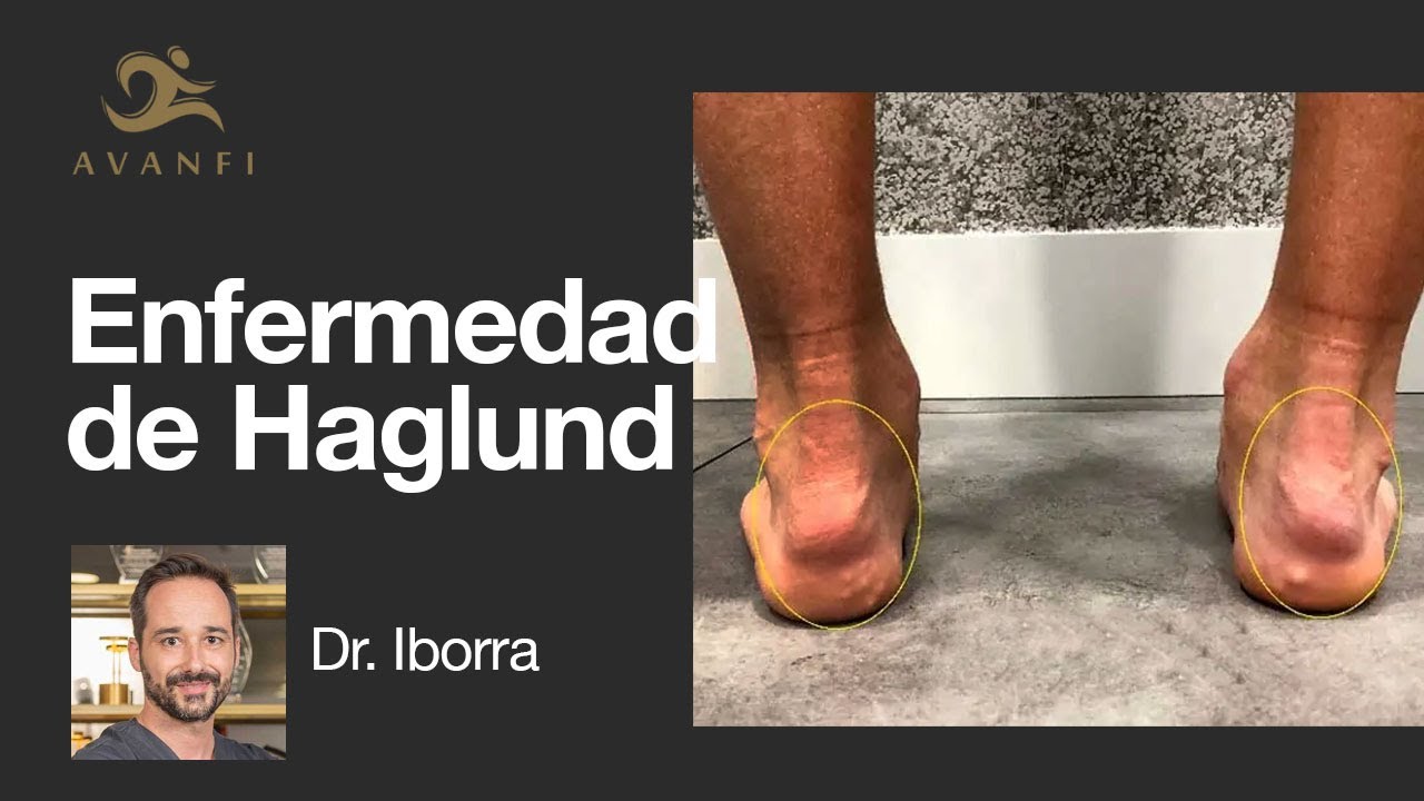 bulto en el talón con dolor
