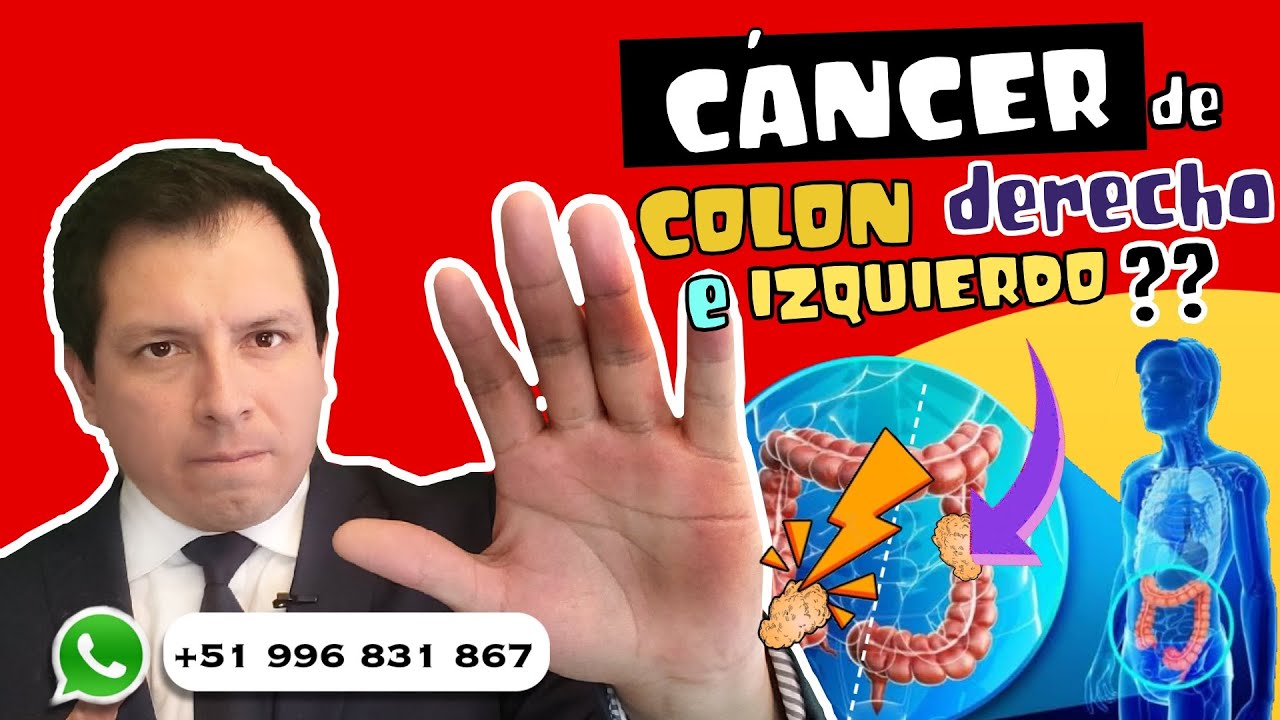 cáncer colon derecho e izquierdo diferencias