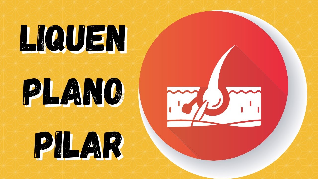 champu para el liquen plano pilar