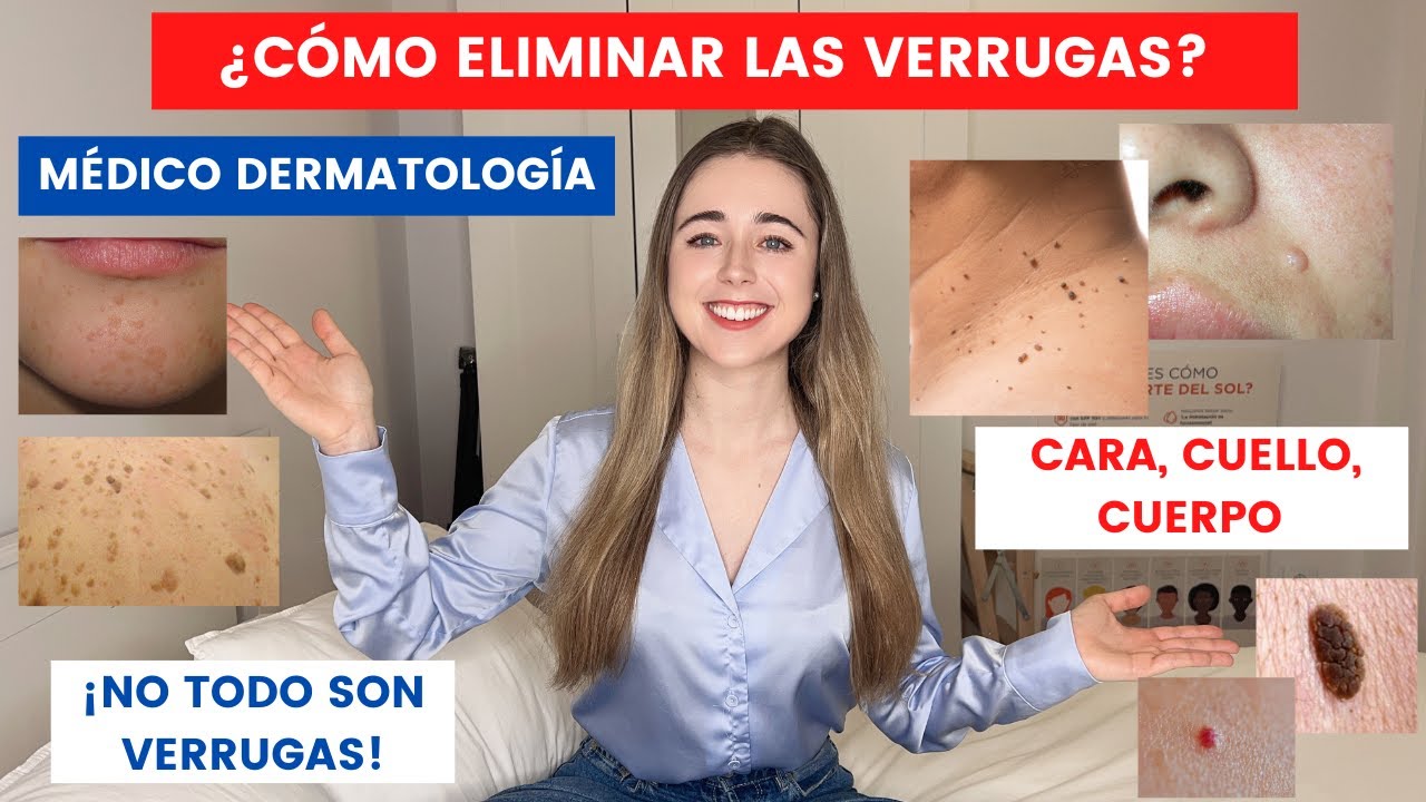 como eliminar verrugas en el cuello