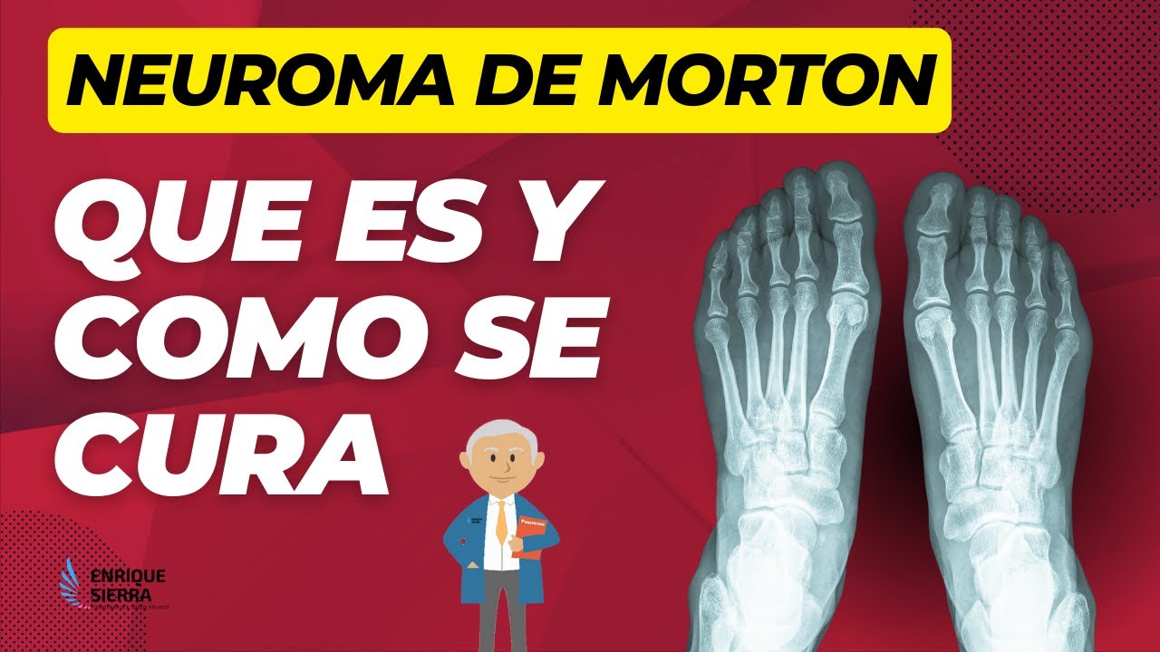 cómo se cura el neuroma de morton