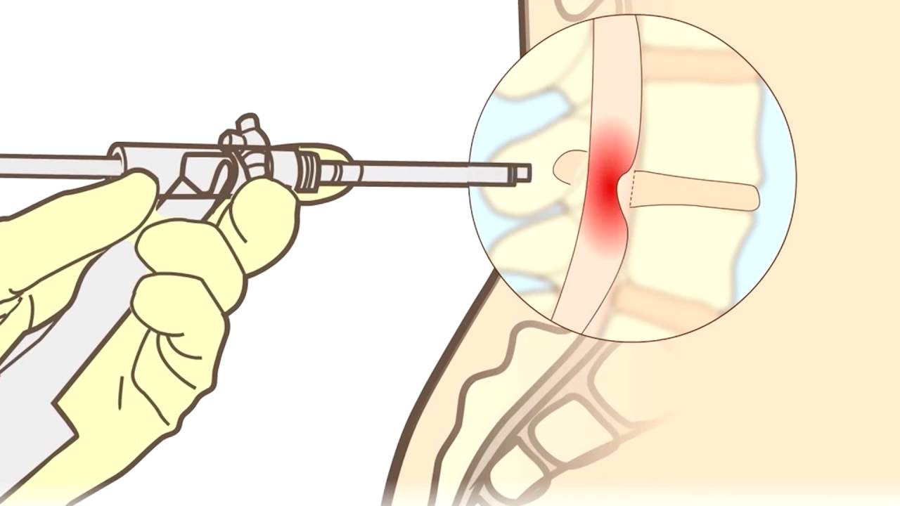 como se opera una hernia discal