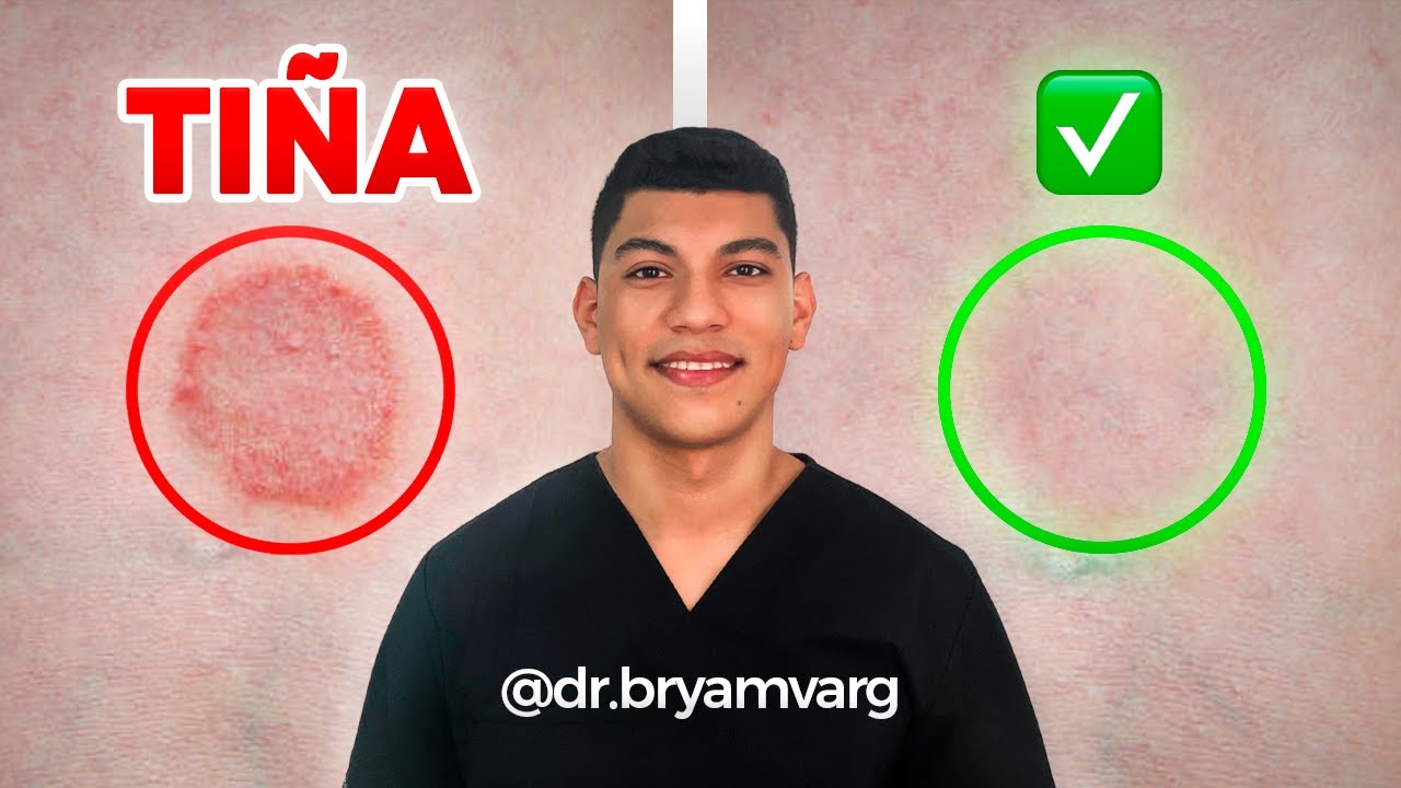 cremas para hongos en el cuello