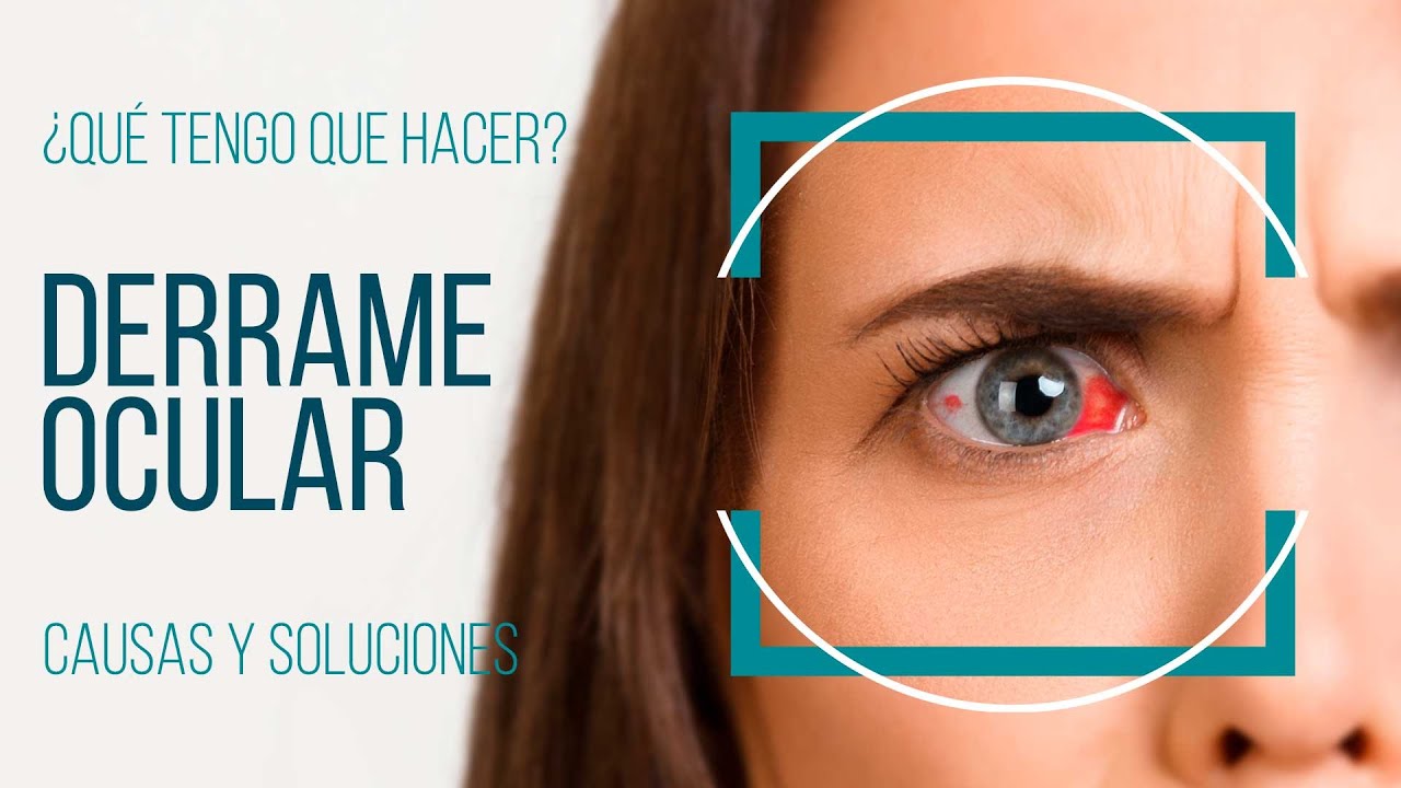 derrames en el ojo por estres