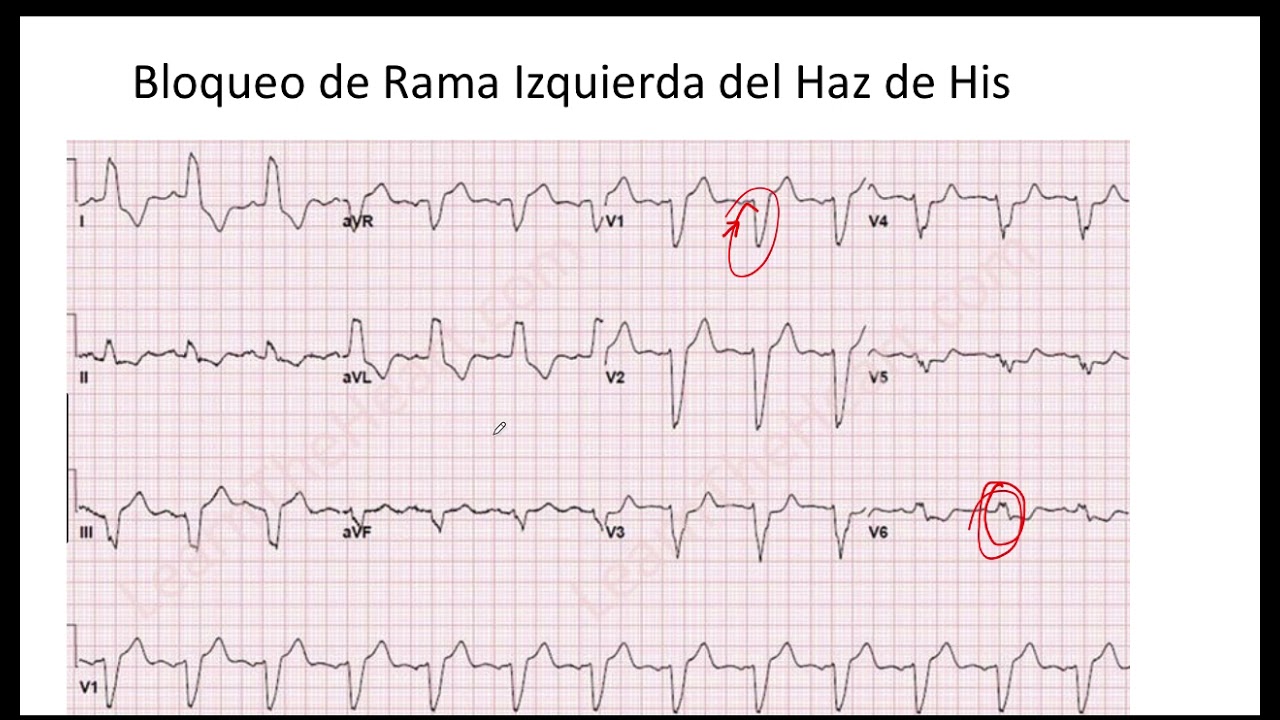 desviacion eje izquierdo corazon es grave