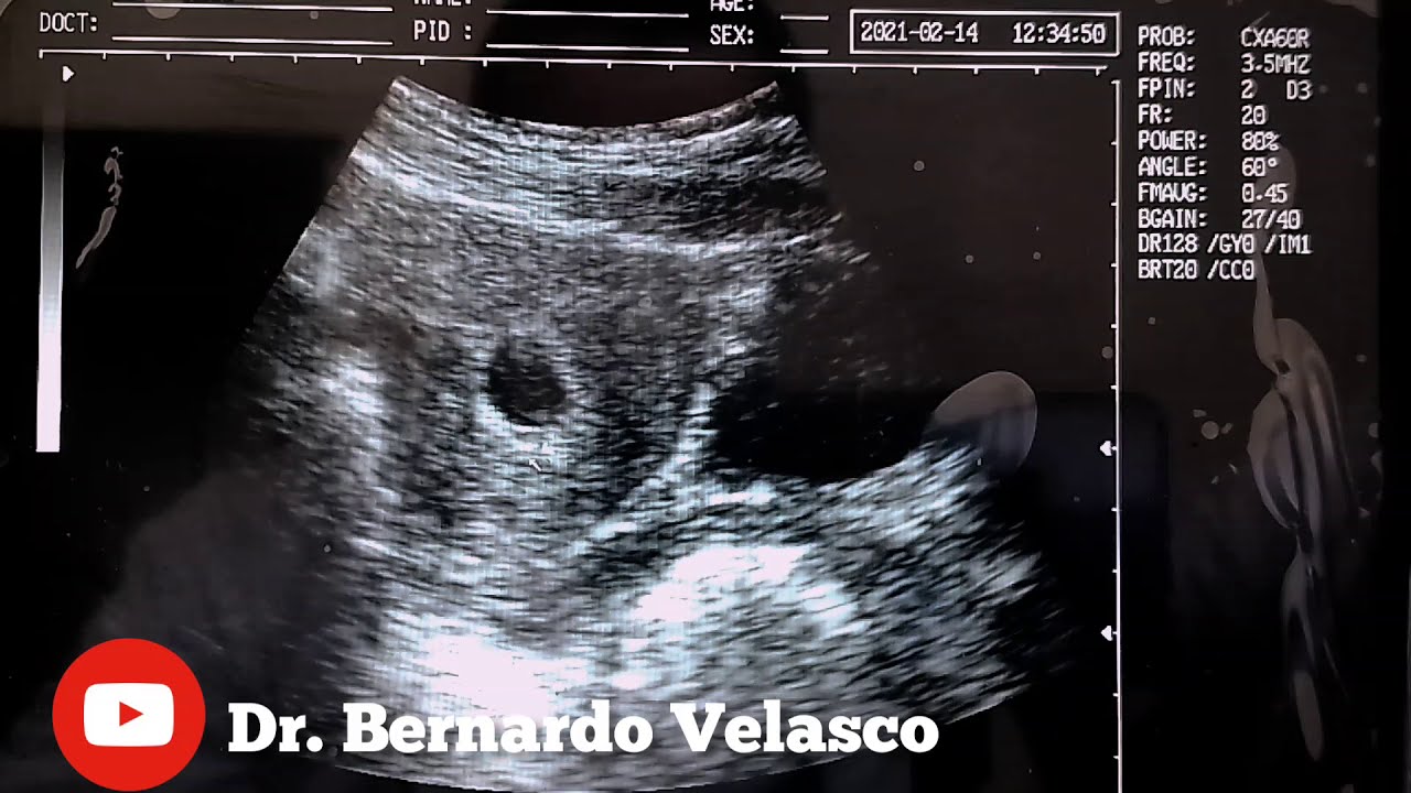 ecografía 5 semanas solo se ve saco