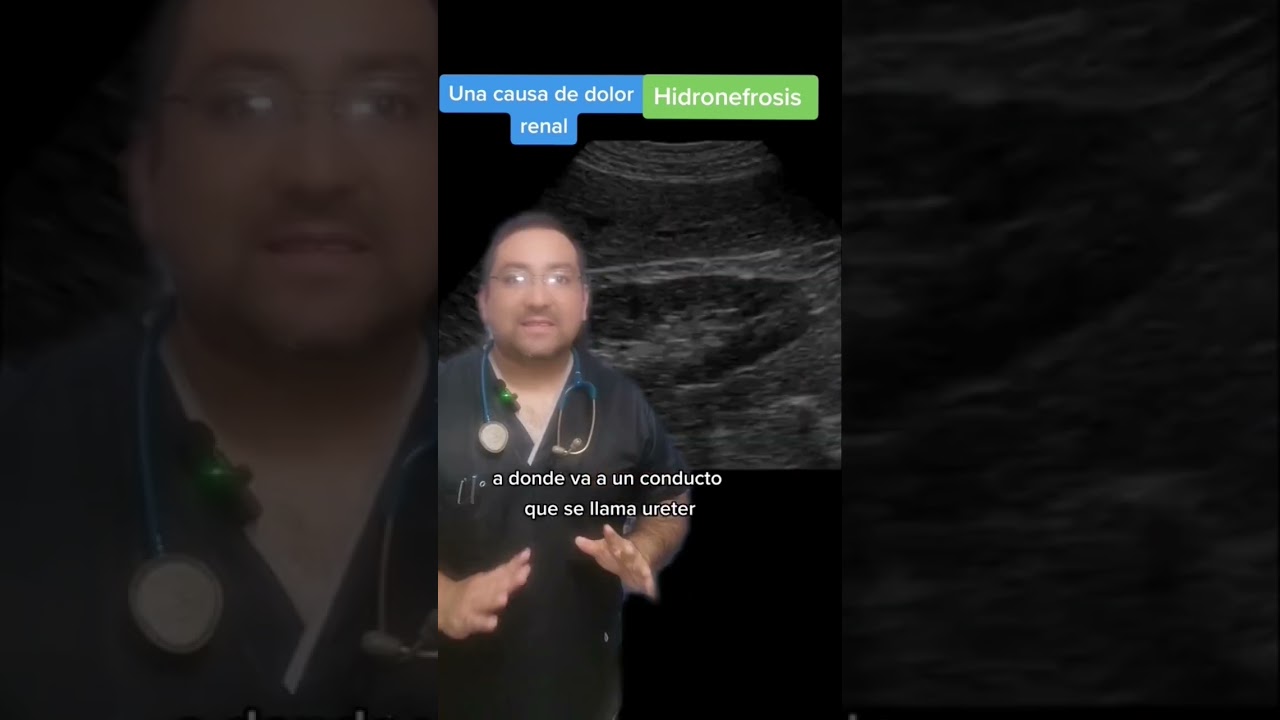 ectasia pielocalicial grado 2 en adultos