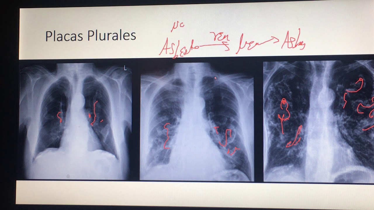 engrosamiento pleural apical bilateral de aspecto residual