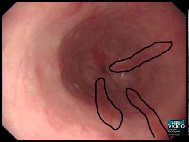 esofagitis gr a de los angeles