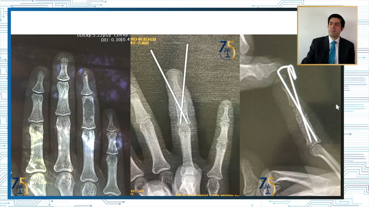 fractura falange proximal 5 dedo mano