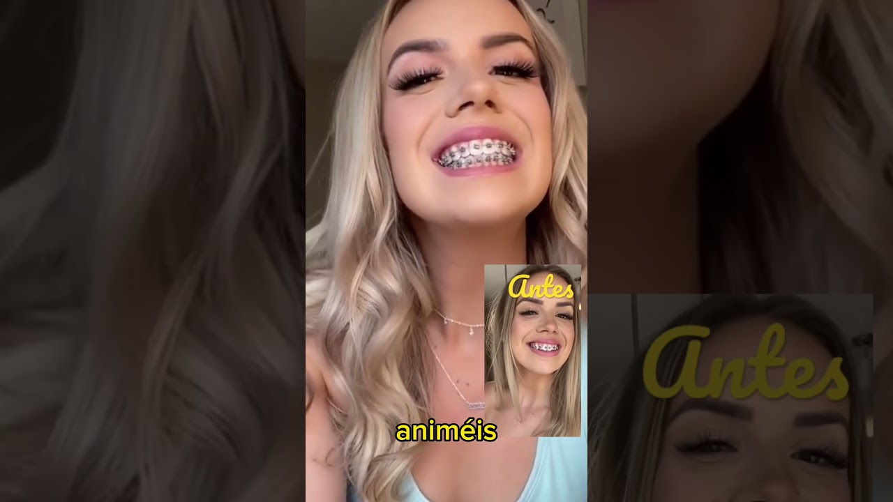 labios antes y después de los brackets